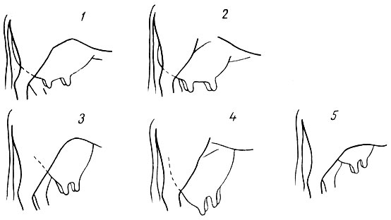 Рис. 14. Форма вымени: 1 - ваннообразное; 2 - чашевидное; 3 - округлосуженное (воронковидное); 4 - козье; 5 - примитивное