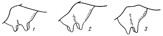 Рис. 16. Разделяющая борозда сбоку вымени, или дольчатость: 1 - слабая; 2 - средняя; 3 - сильно выделяющаяся