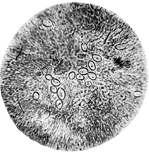 Фото 3. Микроскопия гноя из лимфангоитного узла лошади. Заметны бесцветные эллипсоидальной формы, иногда почкующиеся клетки ('криптококки') гриба Histoplasma farciminosum. Оболочка толстая, двуконтурная. В клетках видны метахроматические зерна. Длина клеток 3-4, ширина 2-3. Висячая капля. X 1000. Ориг