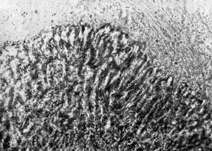 Фото 20. Участок актиномикозной друзы из мокроты человека. Видны колбовидные вздутия мицелия по периферии. Препарат мокроты человека. 450. Ориг