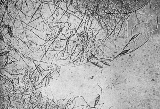 Фото 45. Тонкий мицелий Microsporum lanosum с макроконидиями на конце гиф. Видны отдельные мелкие алейроспоры. Десятидневная культура на сусло-агаре. Рост при 28° Ц. препарат в 50% глицерине. X 100. Ориг