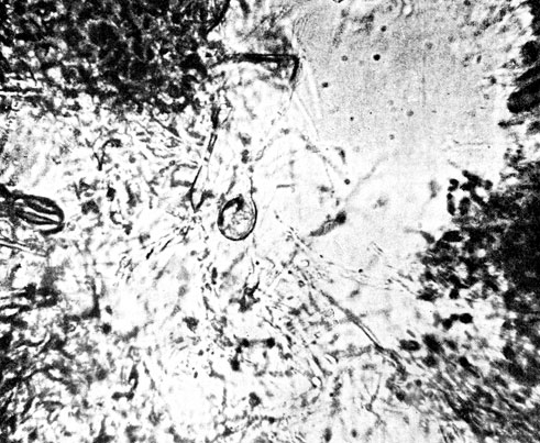 Фото 49. Скопление мицелия Microsporum lanosum и конечная хламидоспора овальной формы с двуконтурной оболочкой (17 x 12,5). Десятидневная культура на сусло-агаре. X 400. Ориг