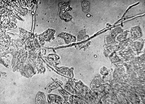 Фото 70. Микроскопический вид наложений на слизистой оболочке зоба цыпленка, больного молочницей. Среди эпителиальных клеток заметны - бесцветный септированный мицелий и овальные бесцветные, единичные дрожжевые клетки диаметром 2,5-6. X 400. Ориг