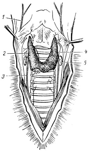 Рис. 7. Щитовидная и паращитовидная железы кролика: 1 - яремная вена; 2 - приблизительное положение внутренней паращитовидной железы; 3 - сонная артерия; 4 - щитовидная железа; 5 - наружная паращитовидная железа
